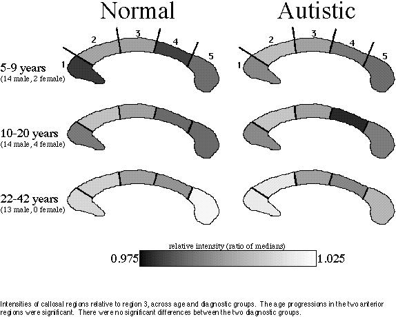 corpus callosum is normally myelinated, so fibres must be absent