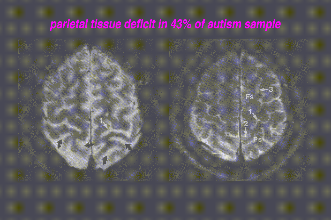 deficit of parietal tissue in 43% of people with autism