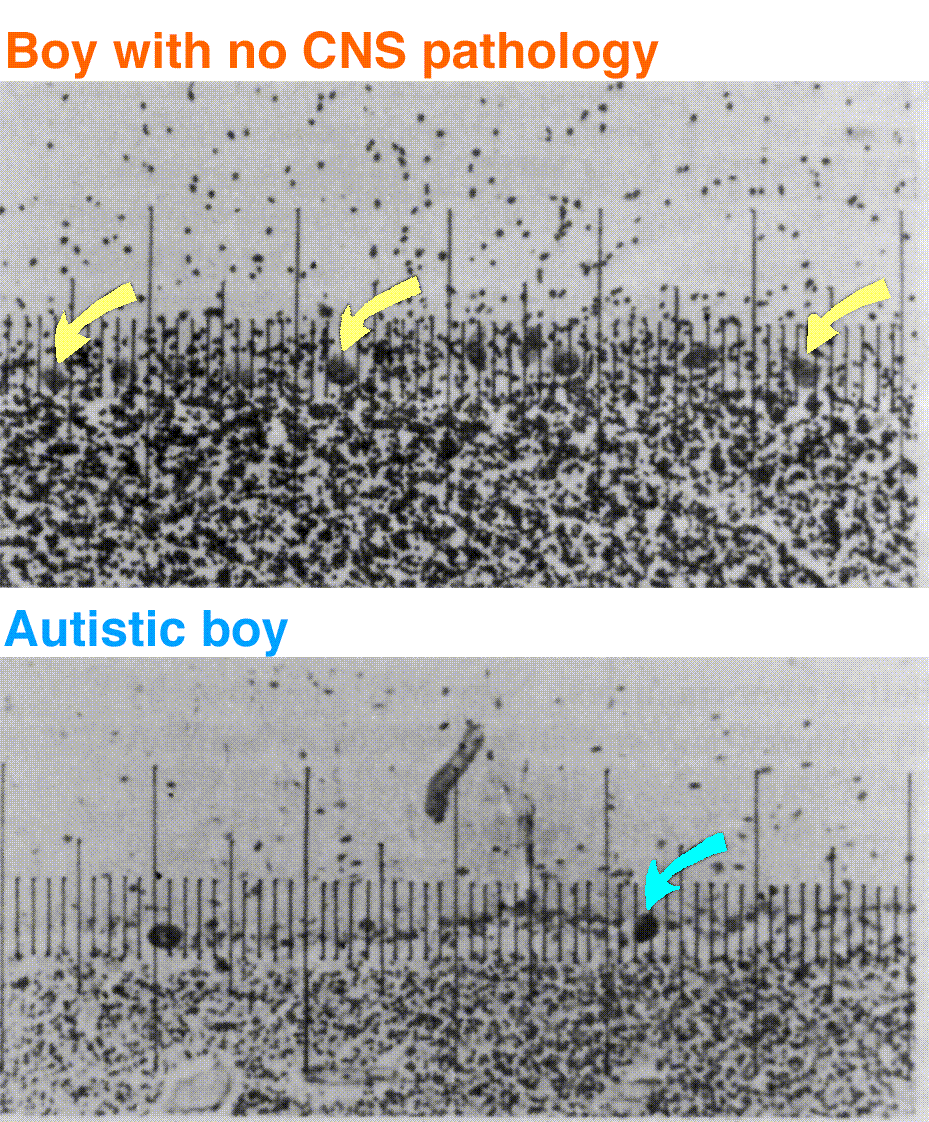 deficit of Purkinje cells