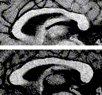narrow posterior corpus callosum