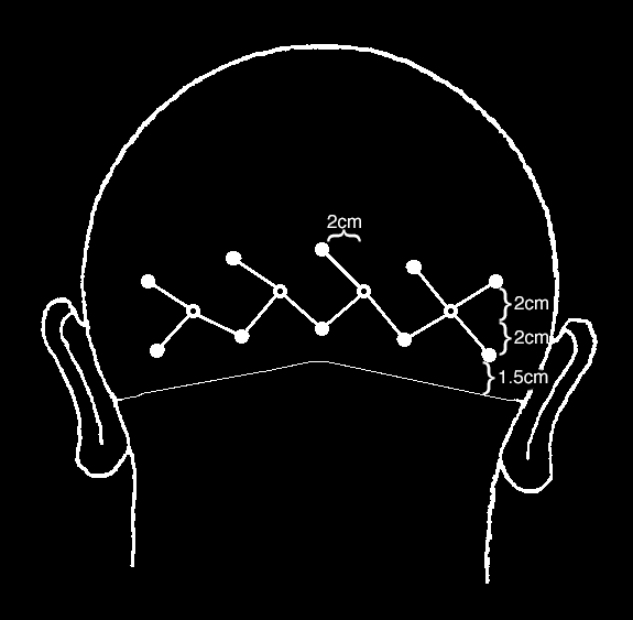 electrode placements