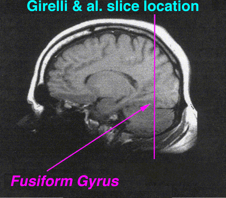 Fusiform gyrus - Wikipedia