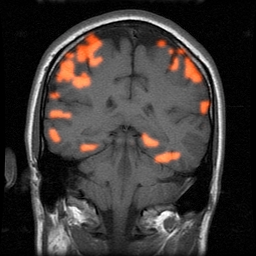 steady-state activation - anterior slice