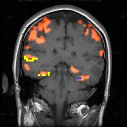 lateralised attentional activation - anterior slice