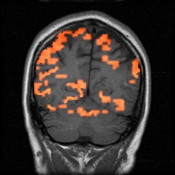 steady-state activation - posterior slice